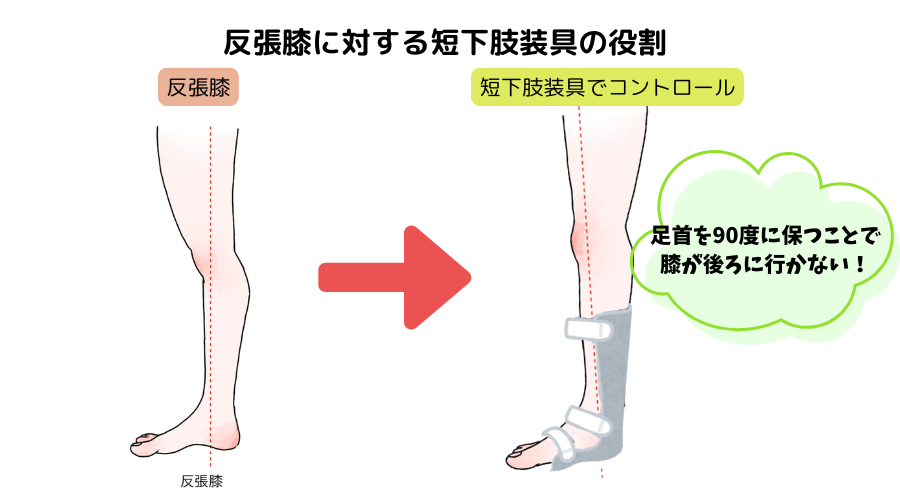 反張膝 装具 左脚 膝の痛みに効果的！おすすめサポーターと靴